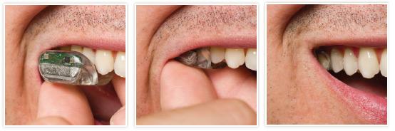 tooth hearing aid